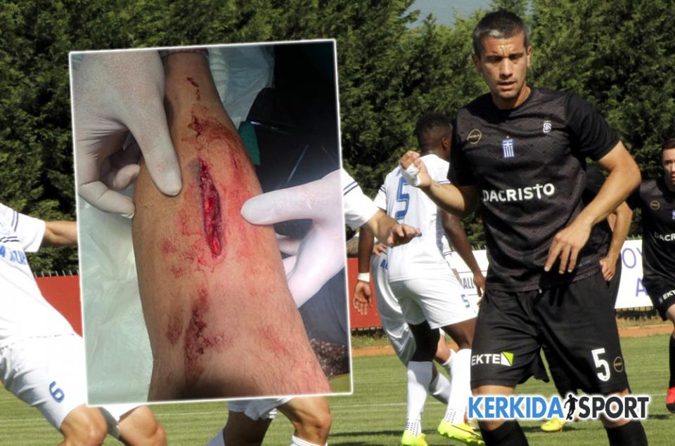 Σοβαρός ο τραυματισμός του Στέλιου Μαραγκού στην Αριδαία (φωτο)